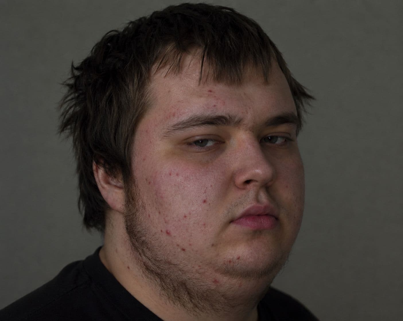 Vorher - Unreinheiten und weiche Jawline